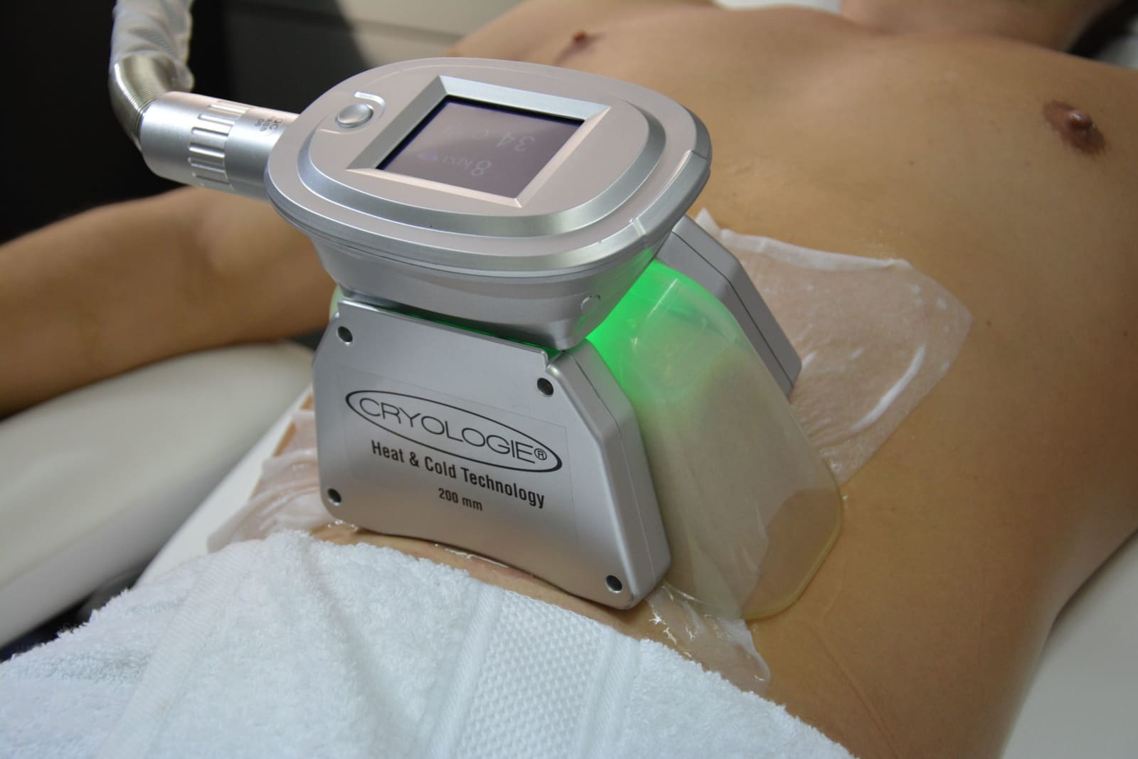Séance de cryolipolyse Cryo Cool Med chez BeautyCRYO Rodez