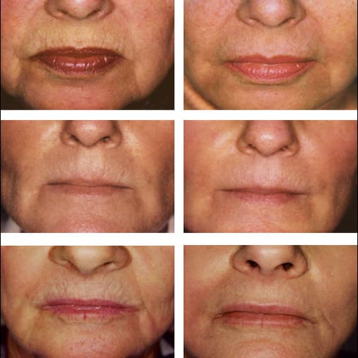 Microdermabrasion aux pointes de diamant à Rodez — BeautyCRYO