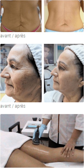 Radiofréquence multipolaire visage à Rodez — BeautyCRYO